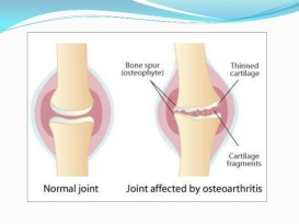 rheumatoid-arthritis-and-osteoarthritis-48-728